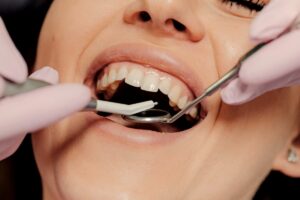 Trattamento conservativo dei denti a Pistoia durante cura della carie e otturazione